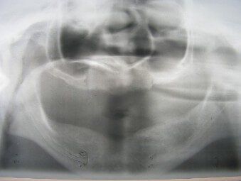 pre-op panorex, full endetulous, top implant dentist, top dental surgeon, implant treatment planning. Rivevriew,Fl. 33578
