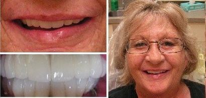 full mouth reconstruction realtion of uppers to lowers. Chris Castellano DMD , top implant dentist , Riverview, Fl. 33578