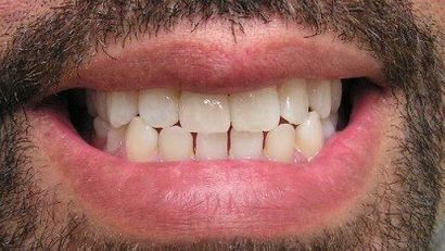 #8 implant restored, Chris Castellano DMD , top implant dentist , Riverview, Fl. 33578