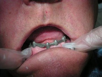 bar cemented over 4 implants for bar retained over denture. Chris Castellano , top implant dentist , Riverview, Fl. 33578