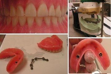 parts for the implant overdenture lab fabricated. Chris Castellano DMD , top implant dentist , Riverview, Fl. 33578