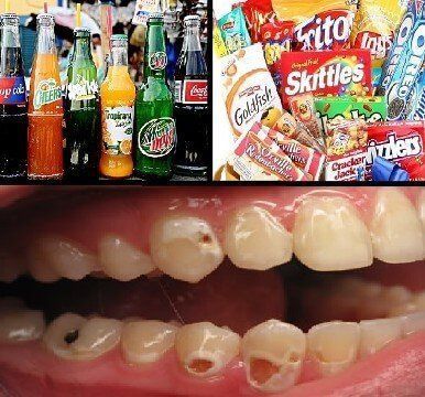 demineralization of tooth structure! from bad diet. Chris Castellano DM, top implant dentist , Riverview, Fl. 33578