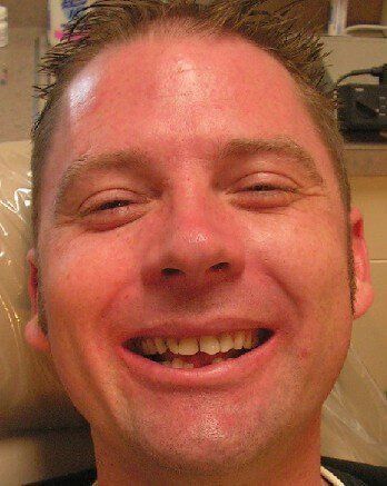 before cosmetic restorations, Chris Castellano DMD, best dentist near me, 33578, Riverview, Fl.