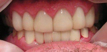 A close up of a person 's teeth with a hairy tongue.
