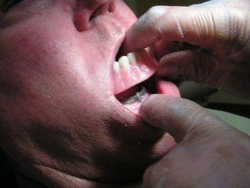 mechanics of bar overdenture. Chris Castellano DMD , top implant dentist , Riverview, Fl. 33578
