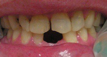 Before cosmetic restoration of anterior teeth. Chris Castellano DMD , top implant dentist , Riverview, Fl. 33578