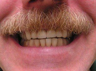 cosmetic restoration of anterior teeth. Chris Castellano DMD , top cosmetic dentist , Riverview, Fl. 33578