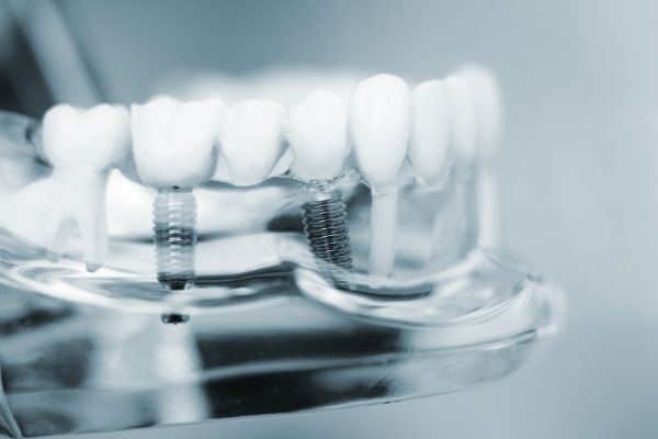Who Is Best Qualified To Do Dental Implants