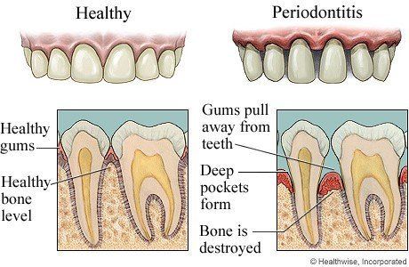 risk factors of periodontal disease. Chris Castellano DMD , top implant dentist , Riverview, Fl. 33578.