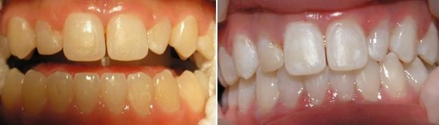 teeth whitening average results! Chris Castellano DMD , top implant dentist , Riverview, Fl. 33578