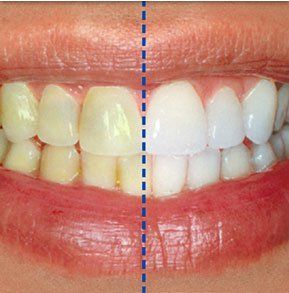 bleaching before and after. Chris Castellano DMD , top dentist , Riverview, Fl. 33578