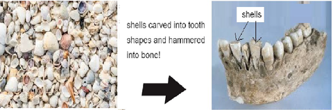 ancient dental shell implants. Chris Castellano DMD , top implant  dentist , Riverview, Fl. 33578