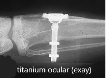 titanium optic used to study cells of the medulary. Chris Castellano DMD, best dentist near me, 33578, Riverview, Fl.  