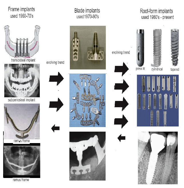 evolvong trend of dental implants.