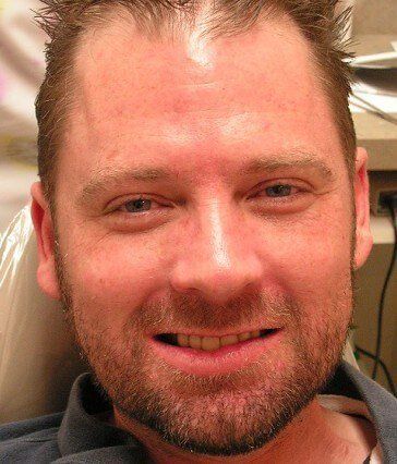 Chris Castellano DMD , top implant dentist , Riverview, Fl. 33578, Happy cosmetically retored patient.