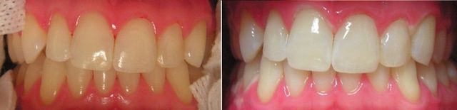 Zoom bleaching! 1 hour chairside bleaching. Chris Castellano DMD , top implant dentist , Riverview, Fl. 33578