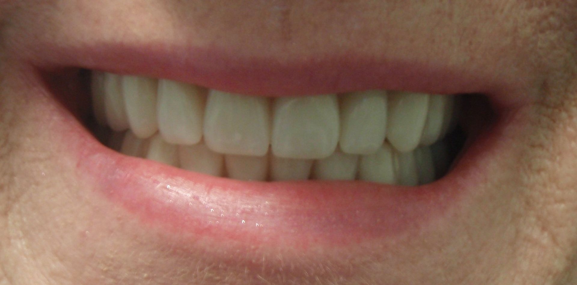 Full Upper & Lower Dentures in gold coast
