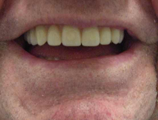 Full Upper Denture services