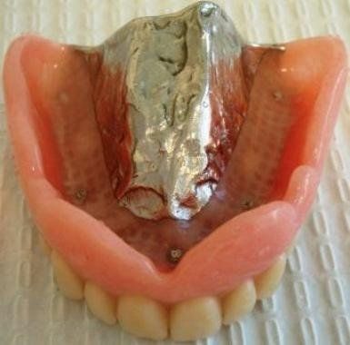 Full Upper Denture With Chrome Palate