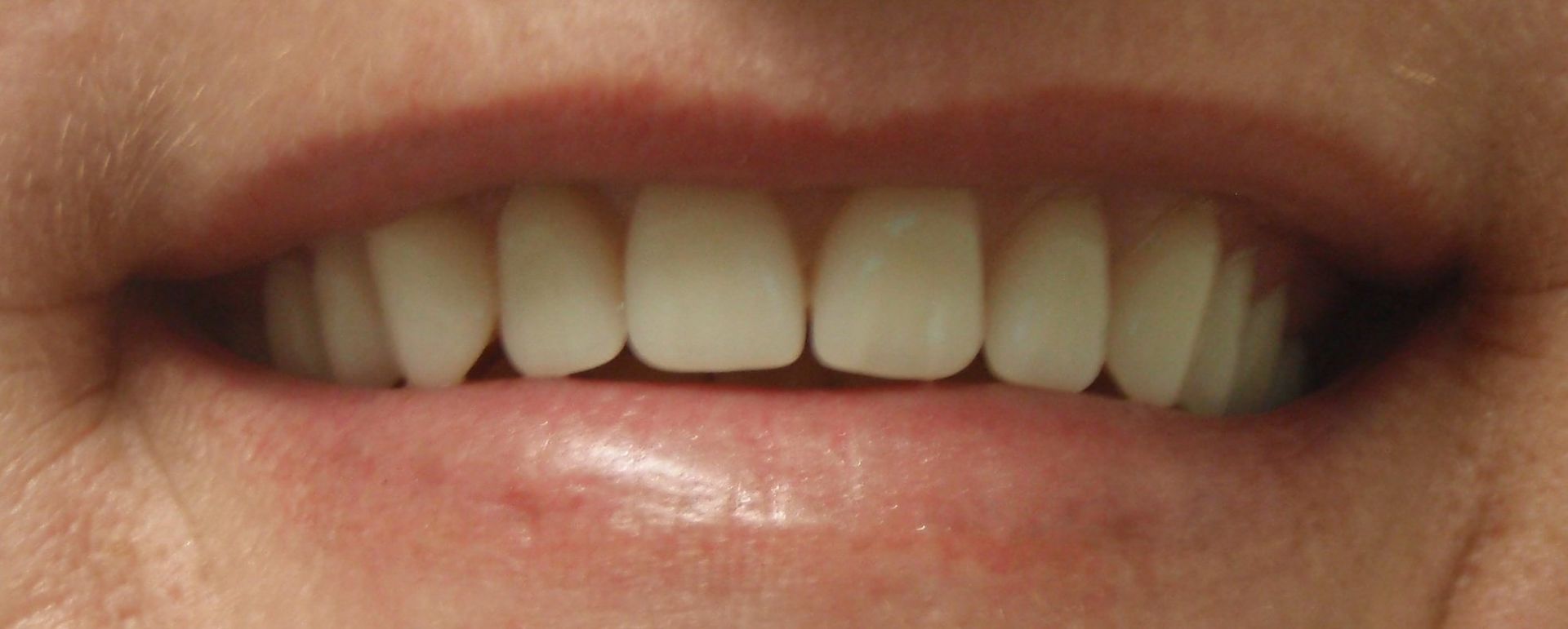 Full Upper Denture