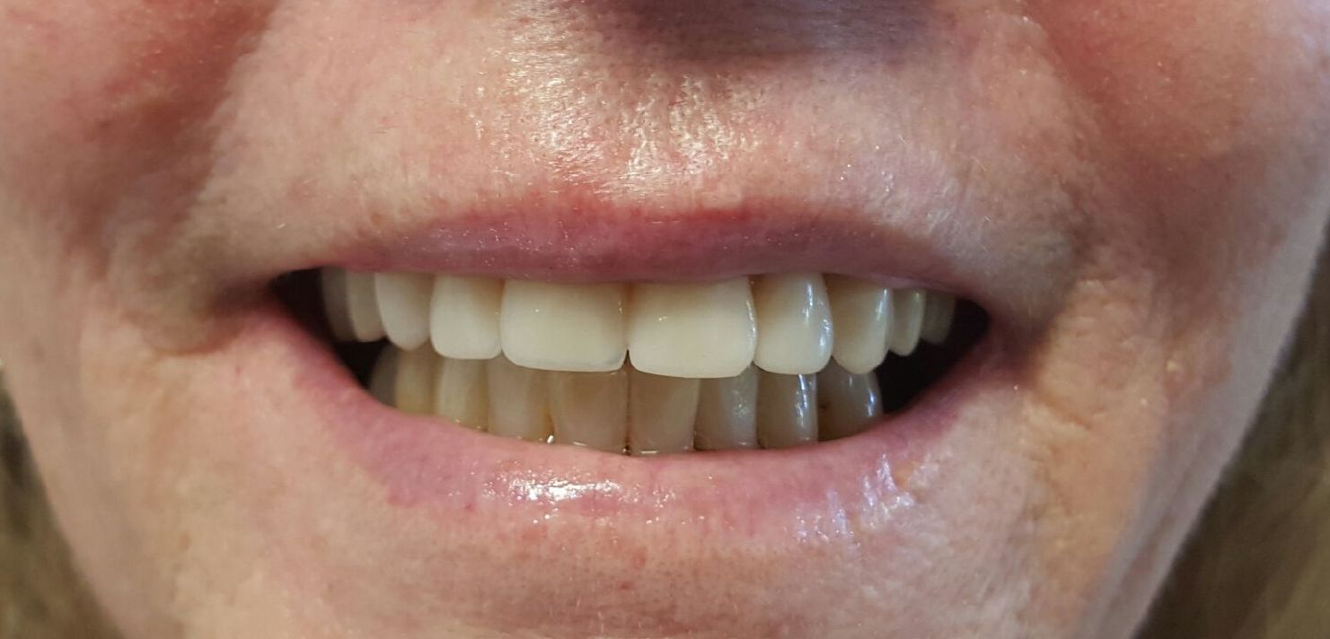 Immediate Denture services gold coast