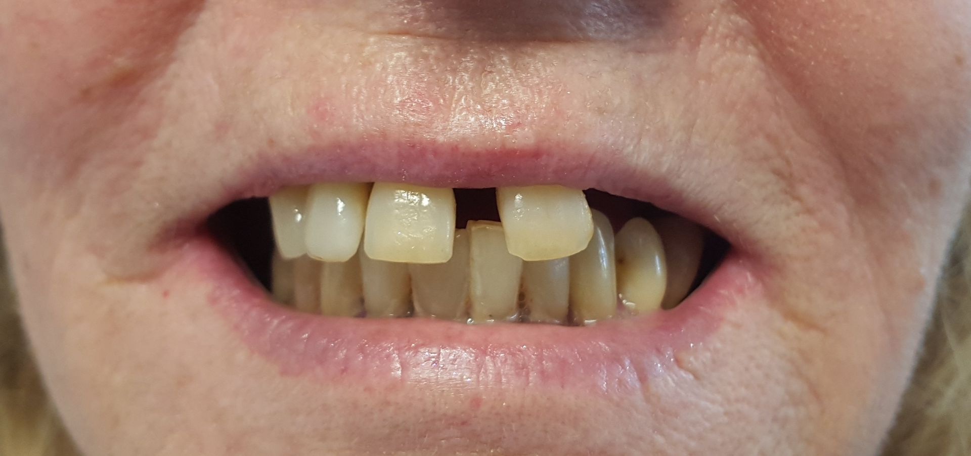 Immediate Denture service