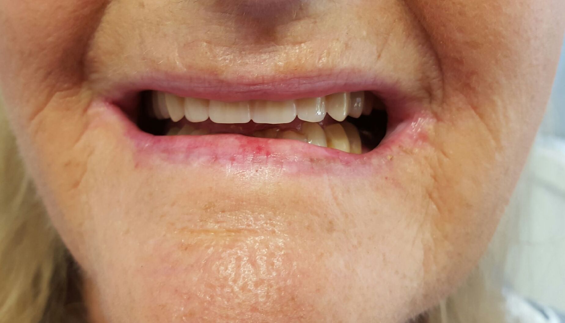 Immediate Denture