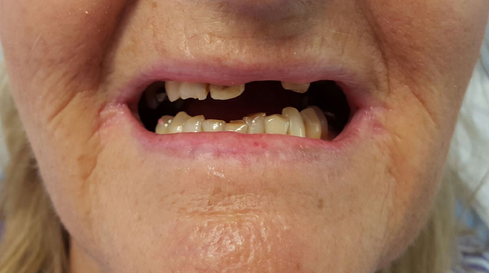 Immediate Denture services