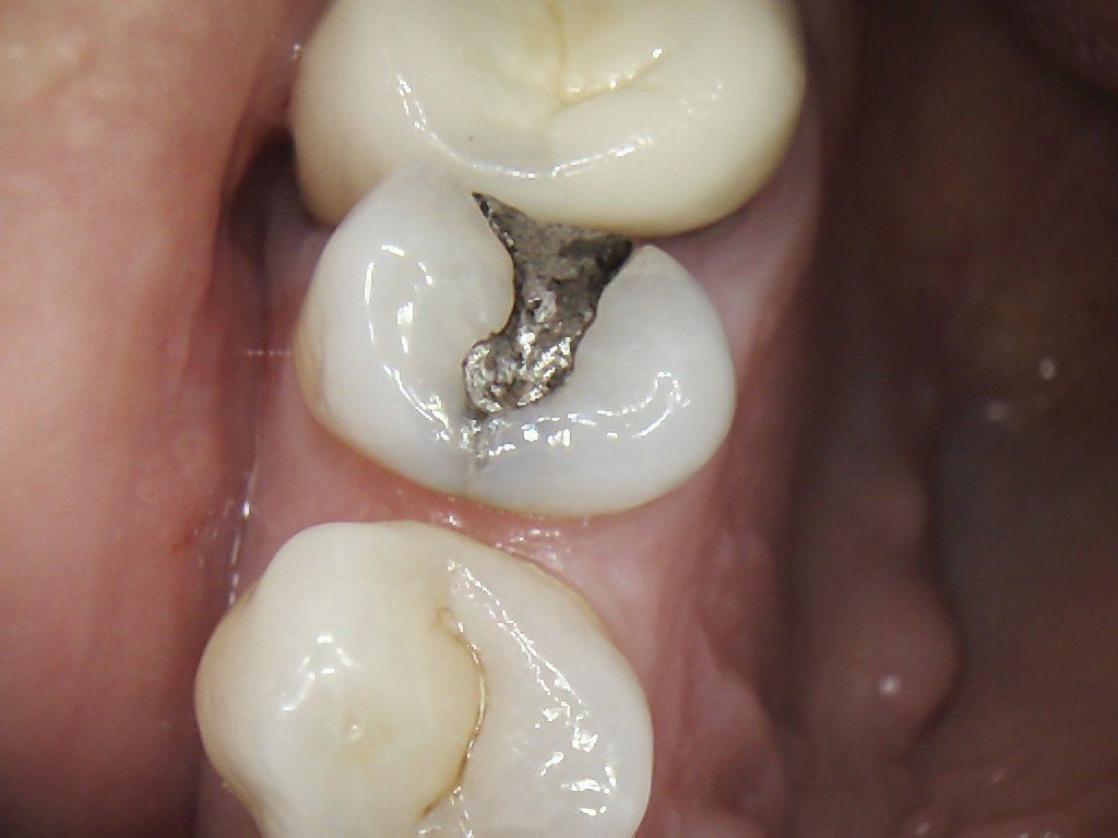 A close up of a person 's teeth with a metal filling in them.