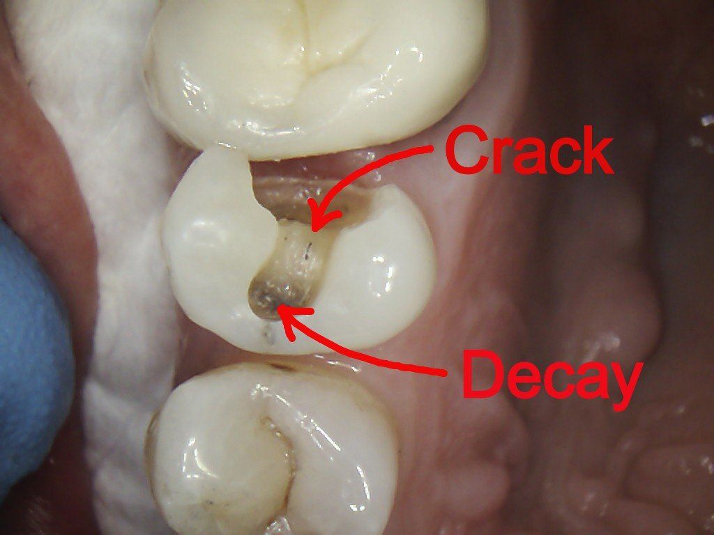 A close up of a tooth with cracks and decay