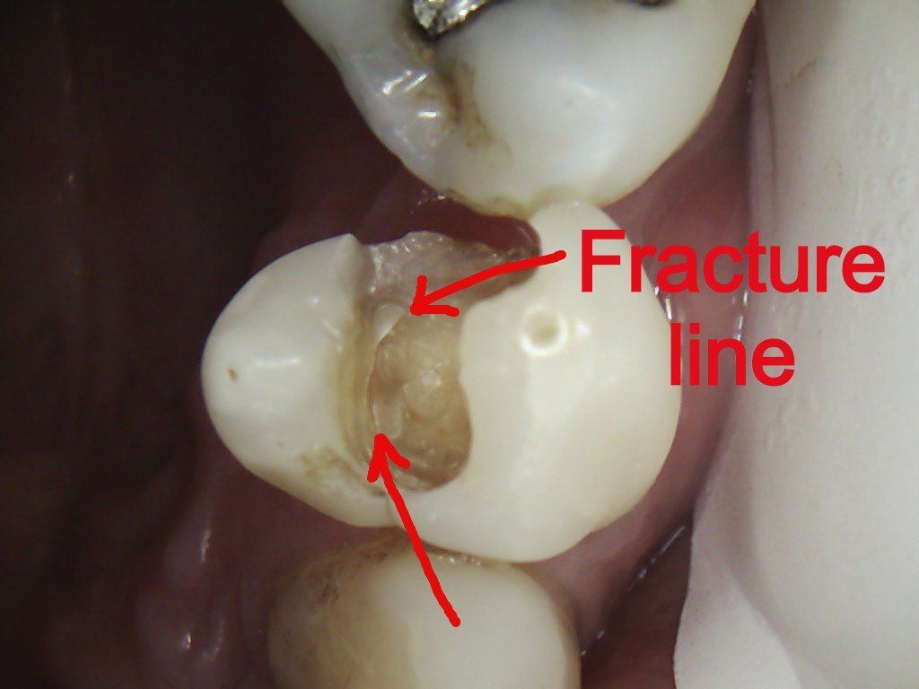 A close up of a tooth with an arrow pointing to the fracture line