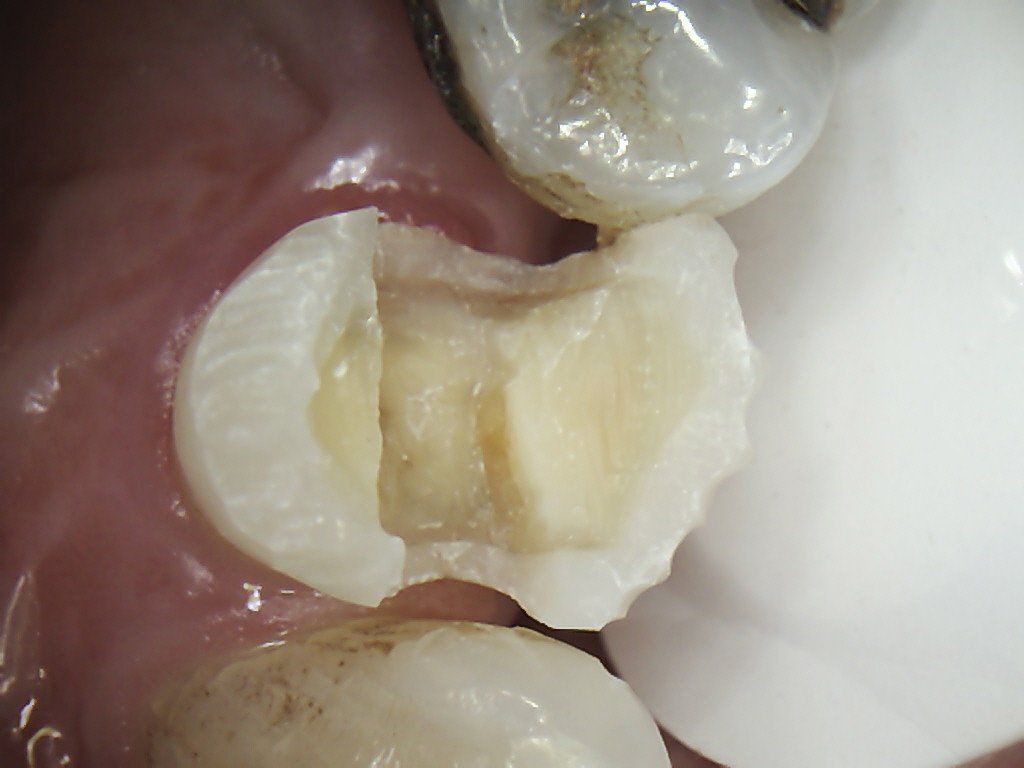 A close up of a tooth with a fracture.