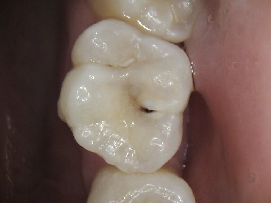 A close up of a tooth with a hole in it.