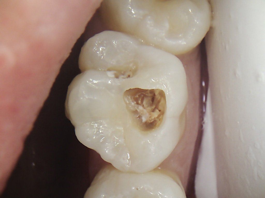 A close up of a tooth with a hole in it