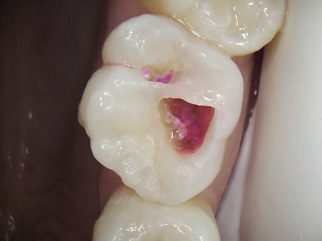 A close up of a tooth with a hole in it.