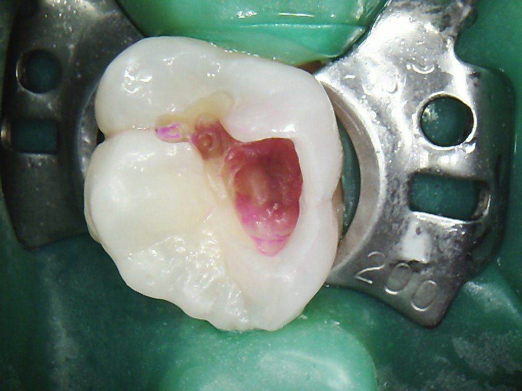 A close up of a tooth with a hole in it.