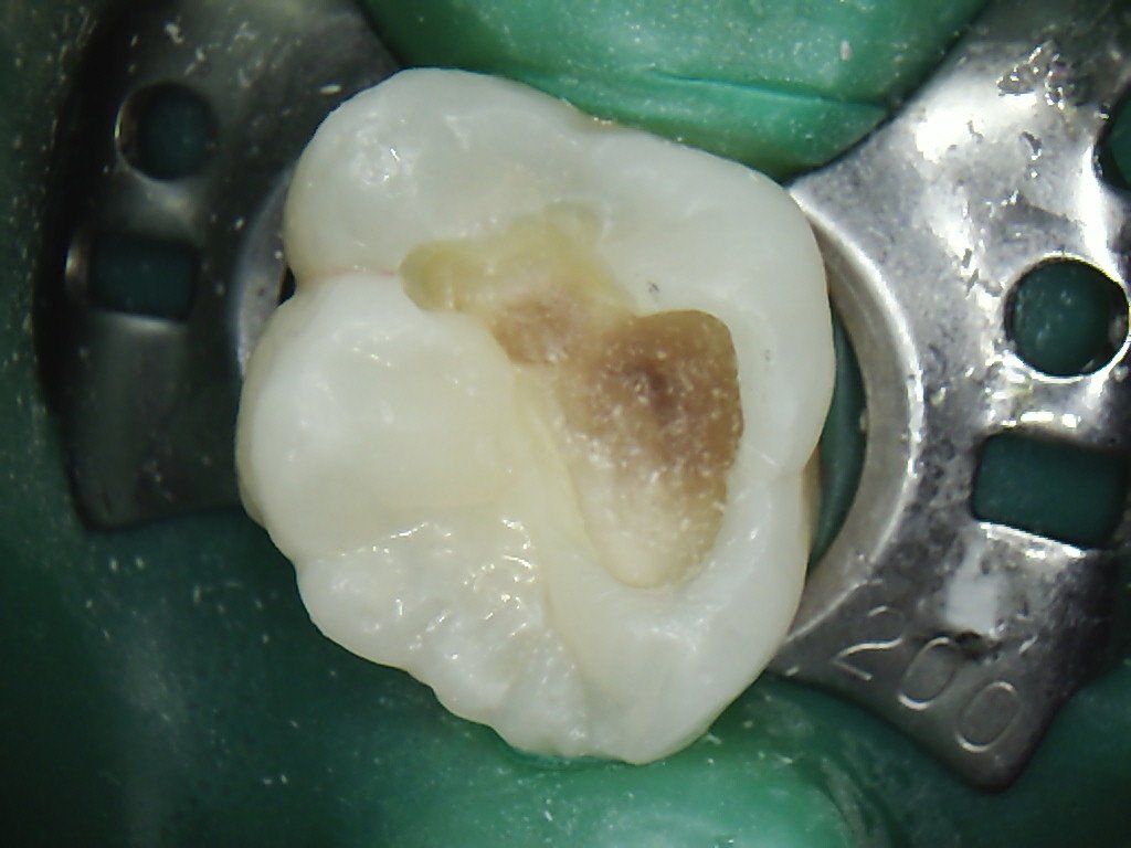 A close up of a tooth with a hole in it.