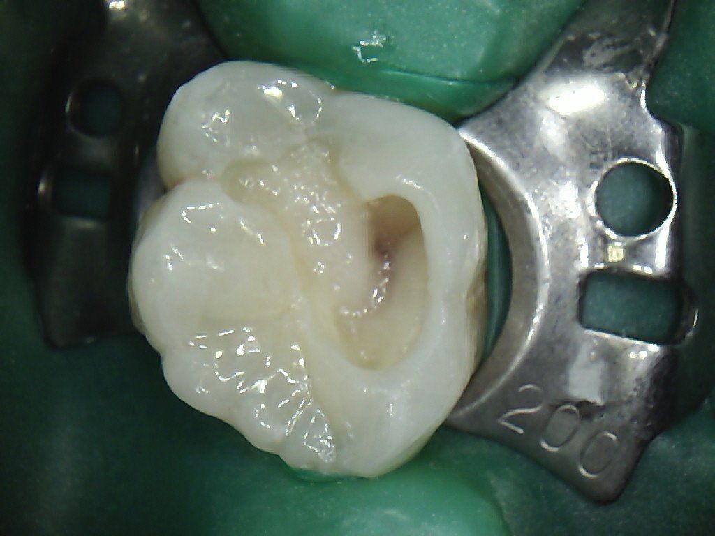 A close up of a tooth with a partially filled hole in it.