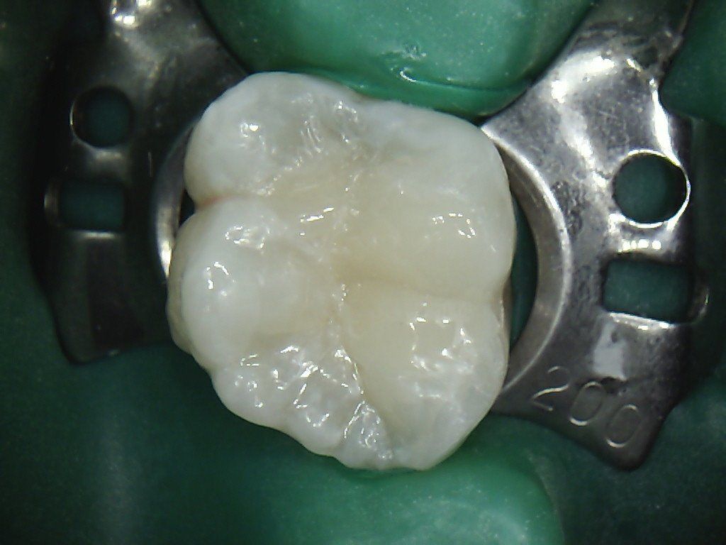 A close up of a tooth with a white filling.