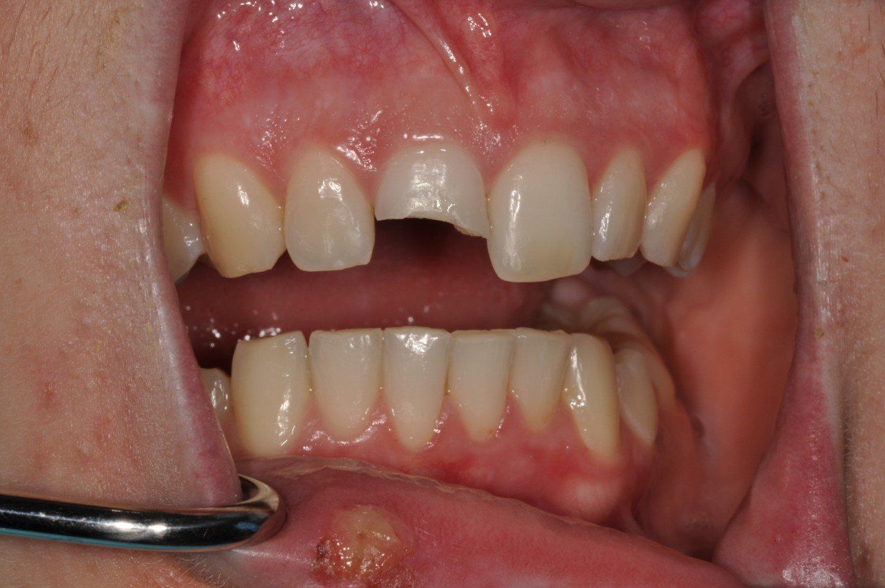 A close up of a person 's mouth with a broken tooth.