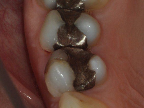 A close up of a person 's teeth with metal fillings.