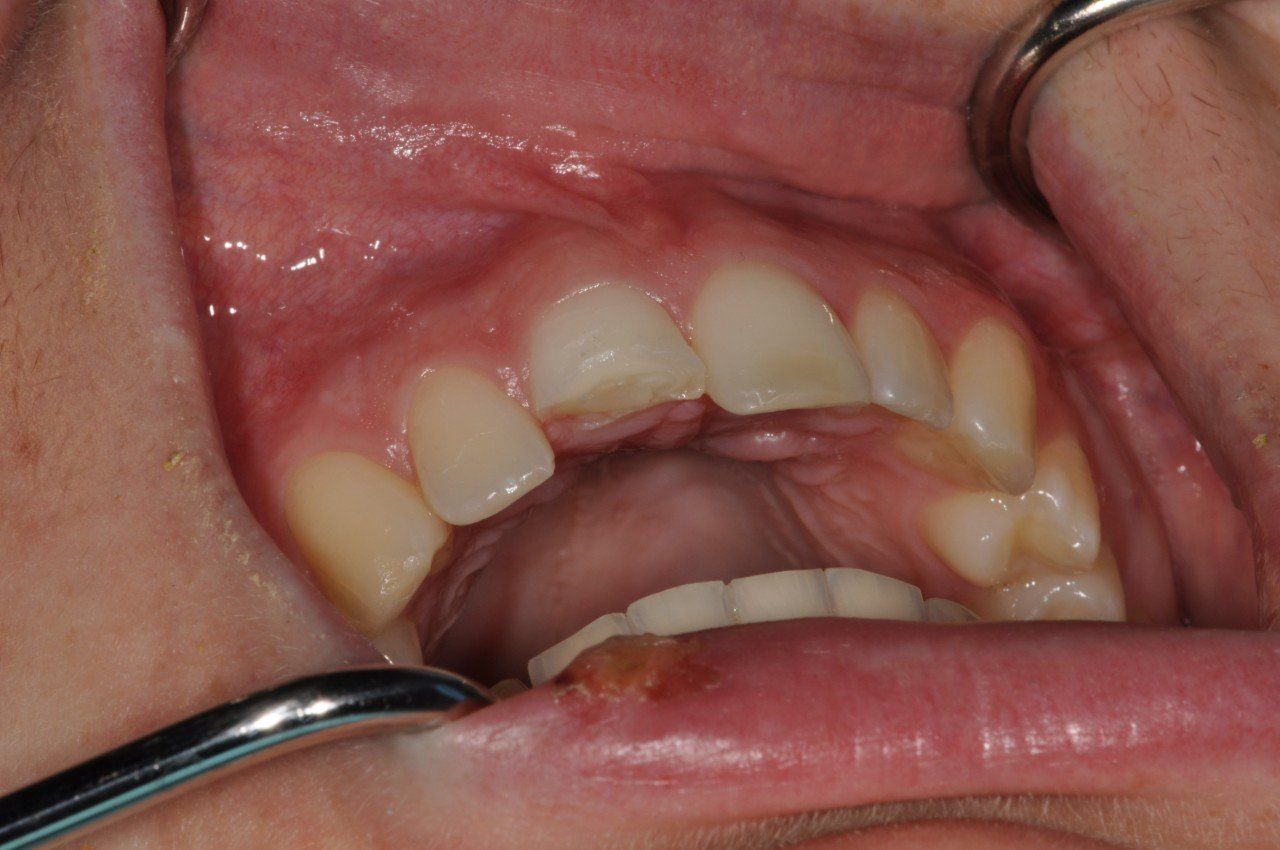 A close up of a person's mouth with a probe in it.