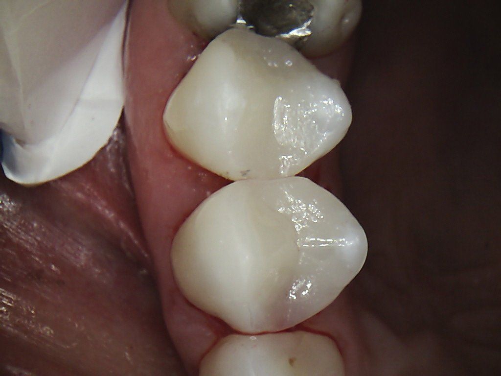 A close up of a person 's teeth with white fillings