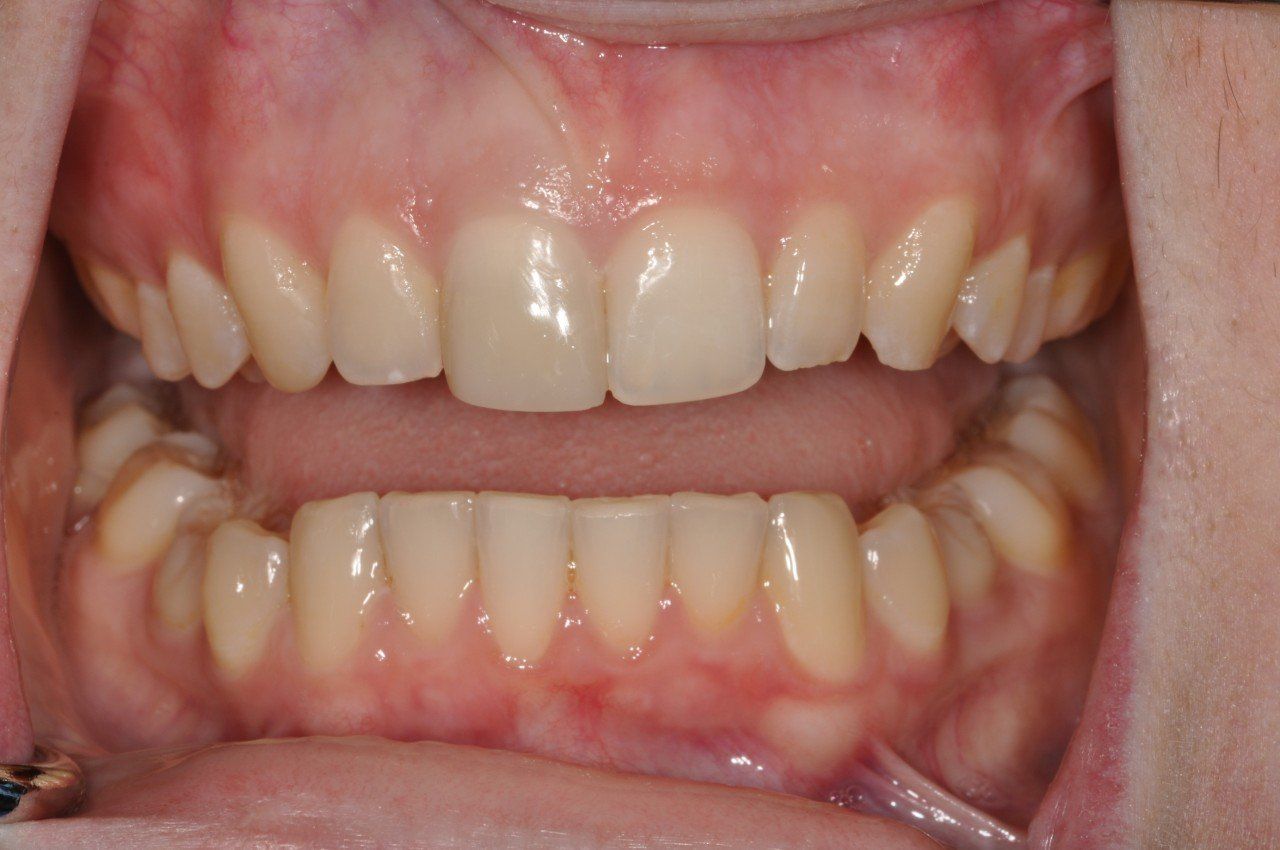 A close up of a person 's mouth with white teeth.