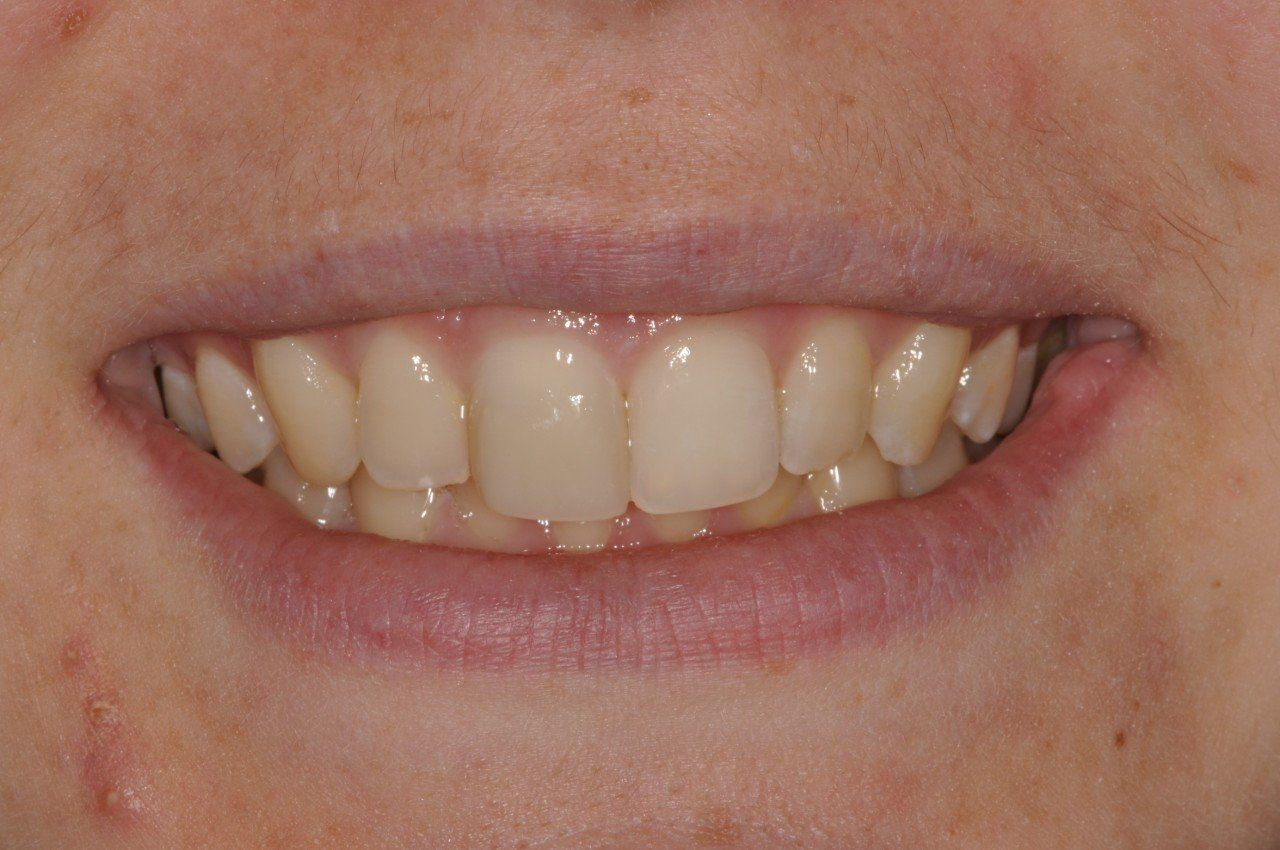 A close up of a person's mouth and teeth.