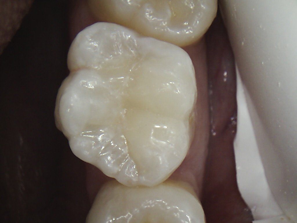 A close up of a tooth with a white filling.