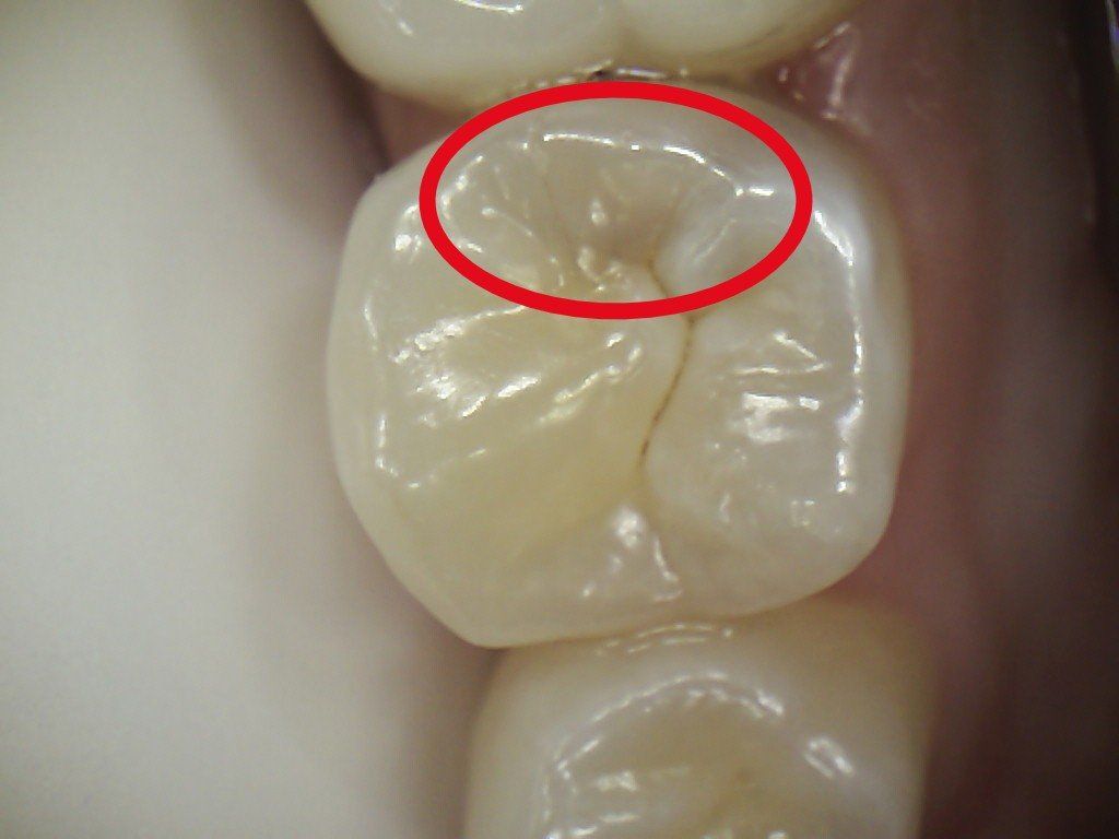 A close up of a tooth with a red circle around it.