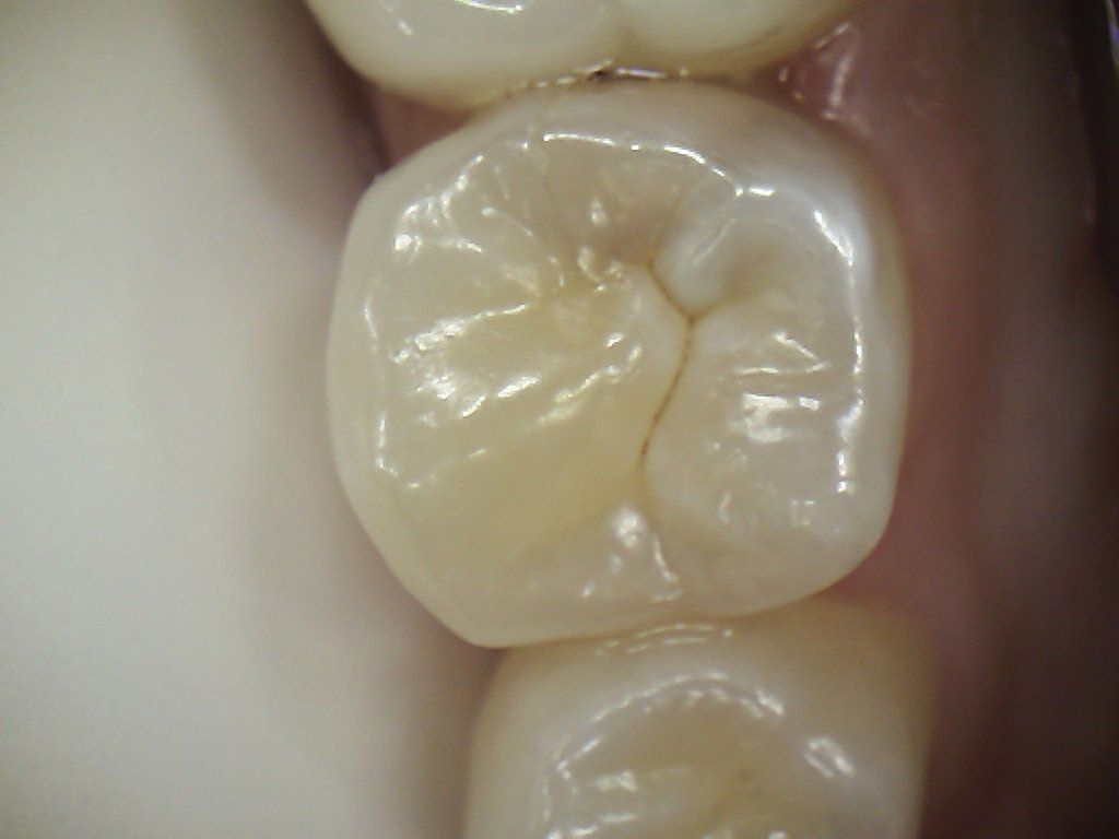 A close up of a tooth with a hole in it