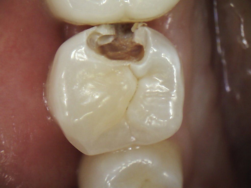 A close up of a tooth with a hole in it.