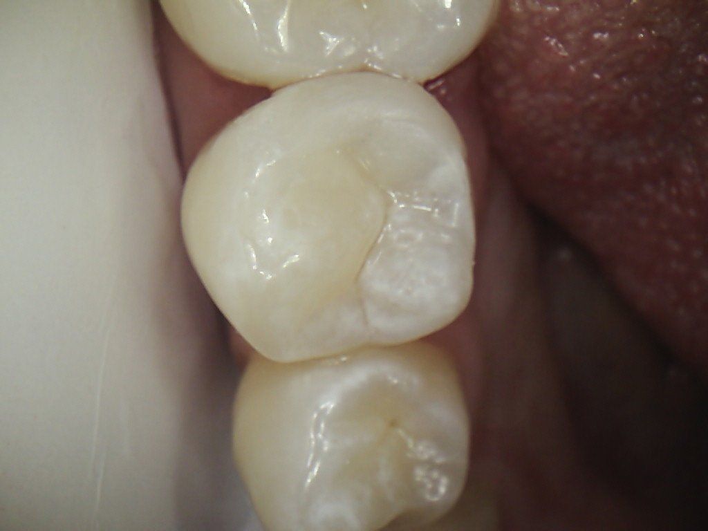A close up of a tooth.
